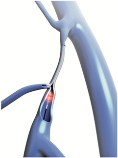 rabota lasera